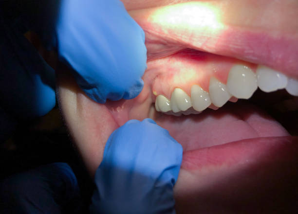 Best Emergency Dentist for Knocked-Out Tooth in Chico, TX